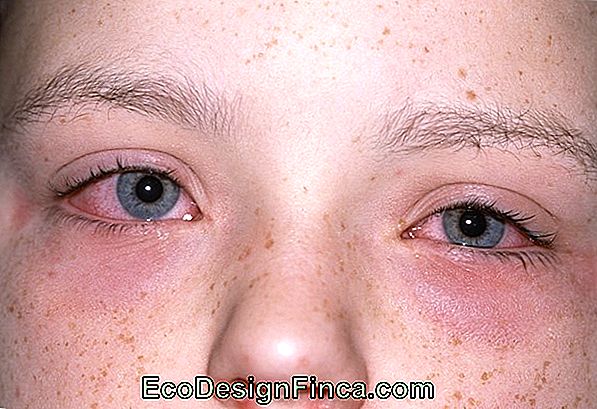 Conjuntivitis Alérgica! Conjuntivitis Alérgica!