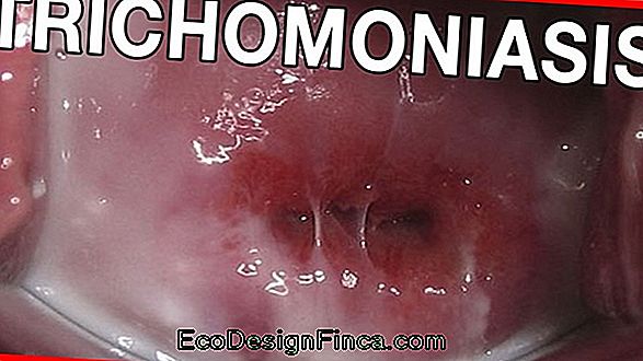 Trichomoniasis...