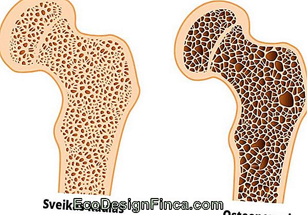 Osteoporoze Izskaidrota Sīkāk